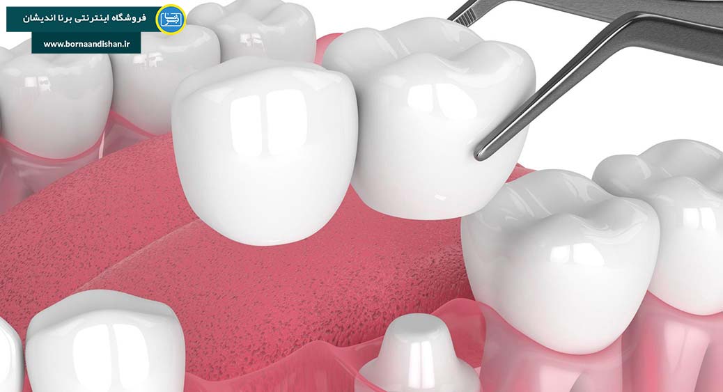 کامپوزیت دندان به چه صورت انجام می شود؟