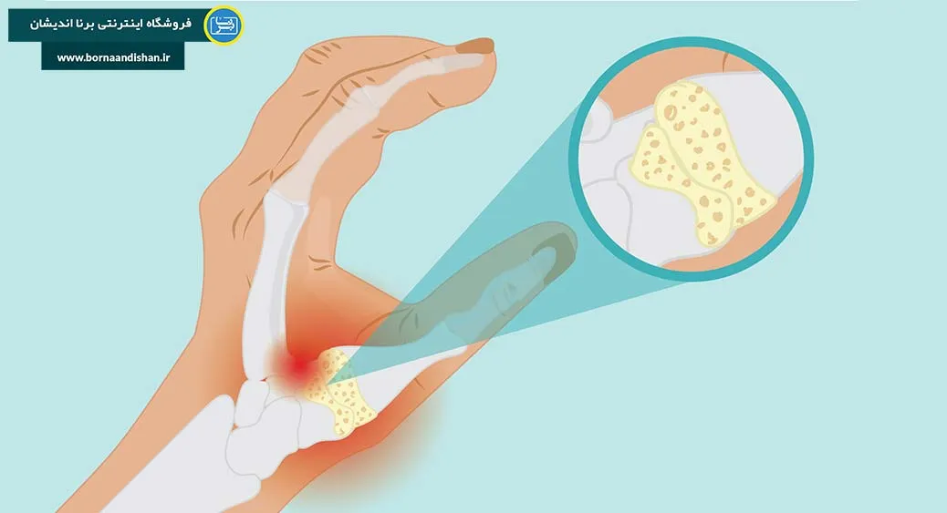 آرتریت انگشت شست: علل و عوامل مؤثر