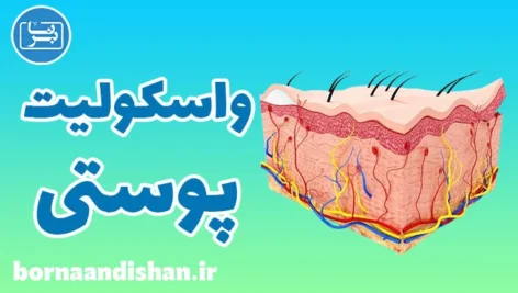 واسکولیت پوستی: تشخیص و درمان