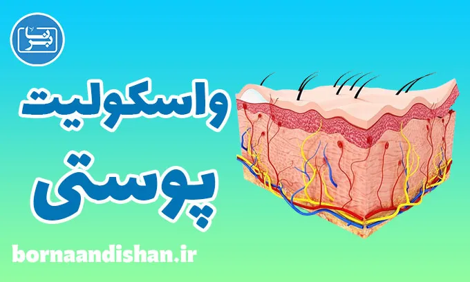 واسکولیت پوستی: تشخیص و درمان