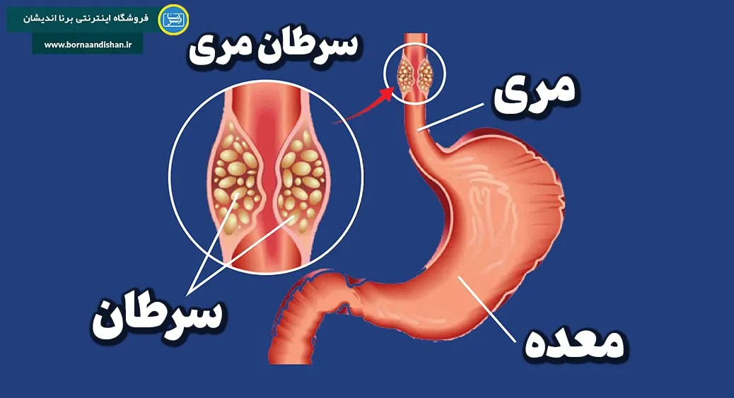 راه‌های درمان سرطان مری