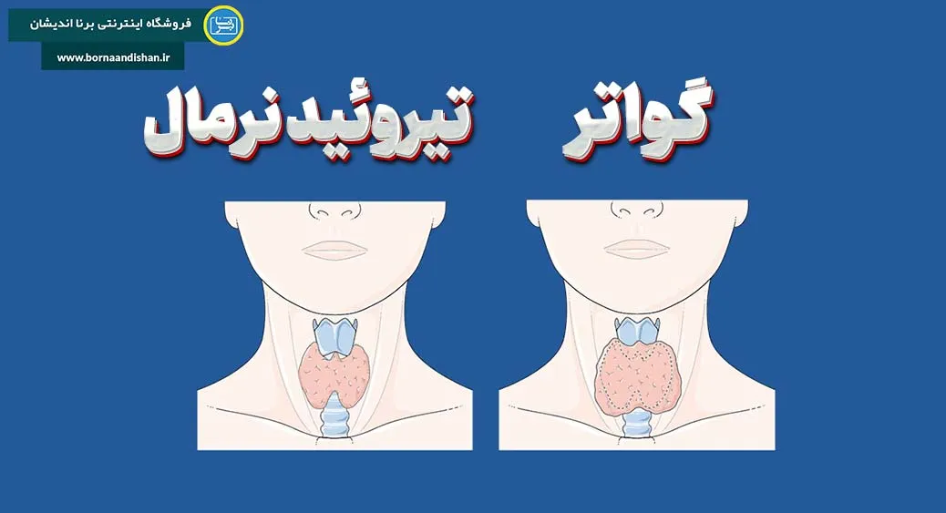 گواتر: یک مهمان ناخوانده در غده‌ی تیروئید