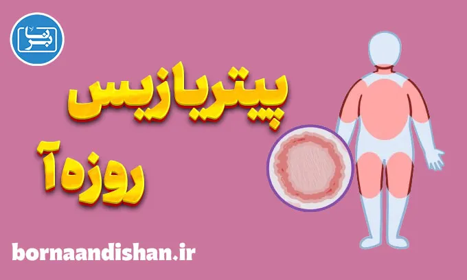 پیتریازیس روزه آ: تشخیص و درمان