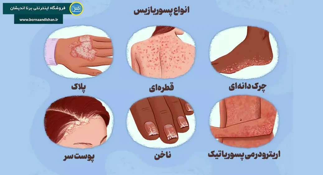 آشنایی با انواع پسوریازیس