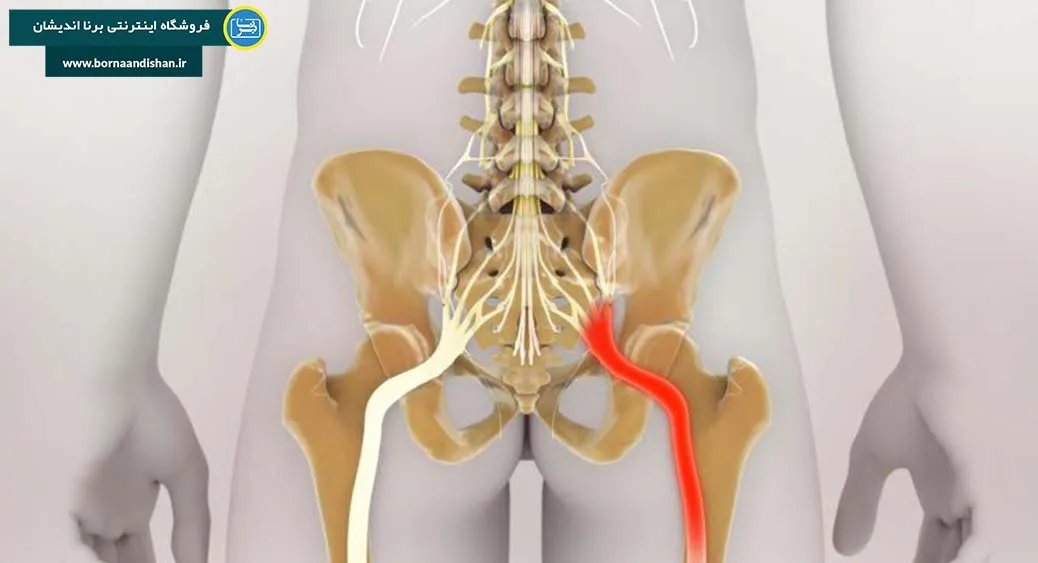 آشنایی با سیاتیک