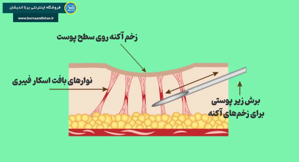 سابسیژن چگونه انجام می‌شود؟